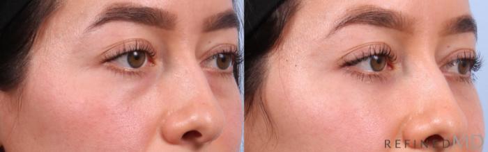 Before & After Lower Eyelid Case 1129 Right Oblique View in Los Gatos & San Jose, CA