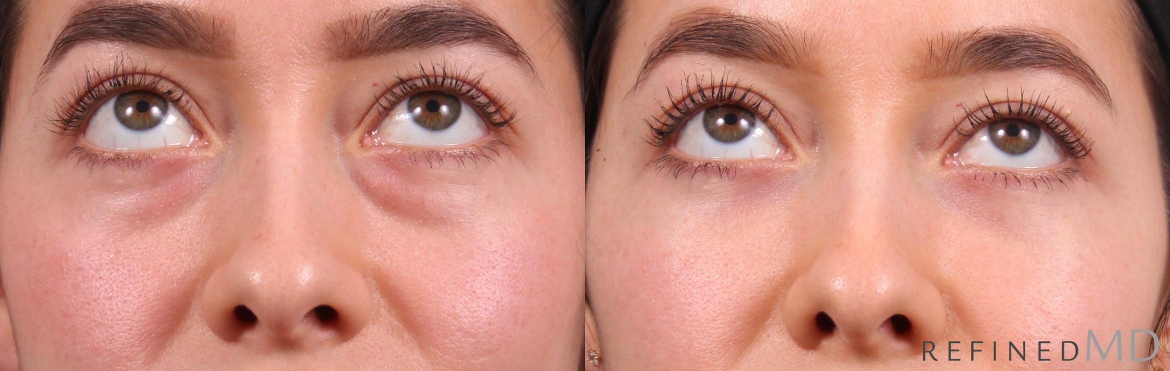 Before & After Lower Eyelid Case 1129 Up Gaze View in Los Gatos & San Jose, CA