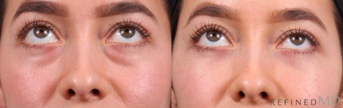 Before & After Lower Eyelid Case 1129 Up Gaze View in Los Gatos & San Jose, CA
