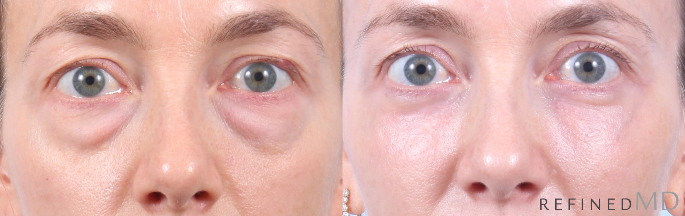 Before & After Lower Eyelid Case 1130 Front View in Los Gatos & San Jose, CA