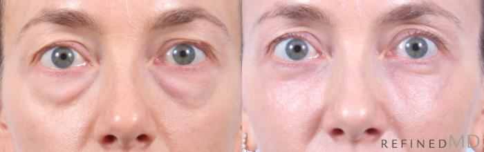 Before & After Lower Eyelid Case 1130 Front View in Los Gatos & San Jose, CA