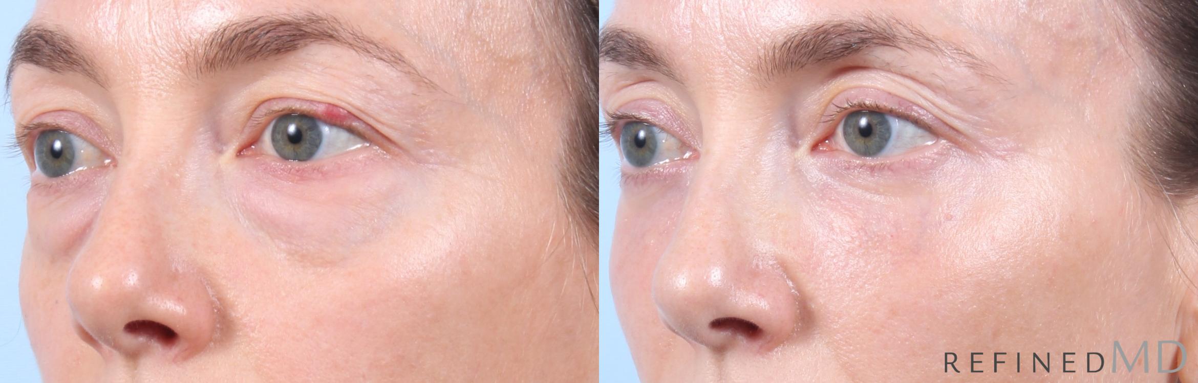 Before & After Lower Eyelid Case 1130 Left Oblique View in Los Gatos & San Jose, CA