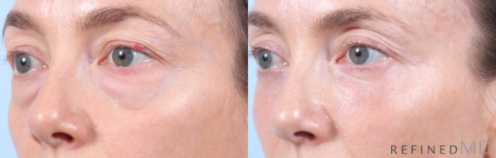 Before & After Lower Eyelid Case 1130 Left Oblique View in Los Gatos & San Jose, CA