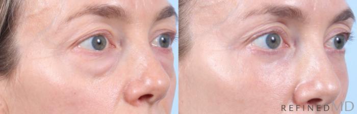 Before & After Lower Eyelid Case 1130 Right Oblique View in Los Gatos & San Jose, CA