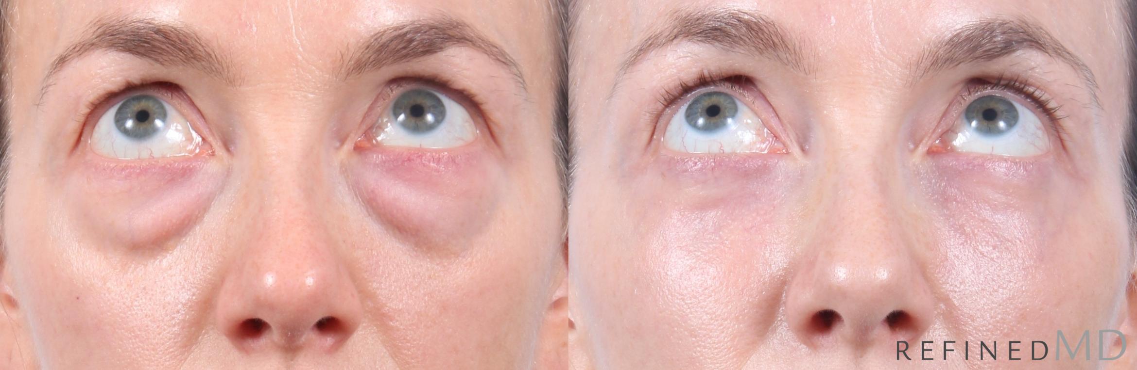 Before & After Lower Eyelid Case 1130 Up Gaze View in Los Gatos & San Jose, CA