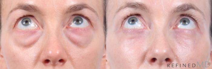 Before & After Lower Eyelid Case 1130 Up Gaze View in Los Gatos & San Jose, CA