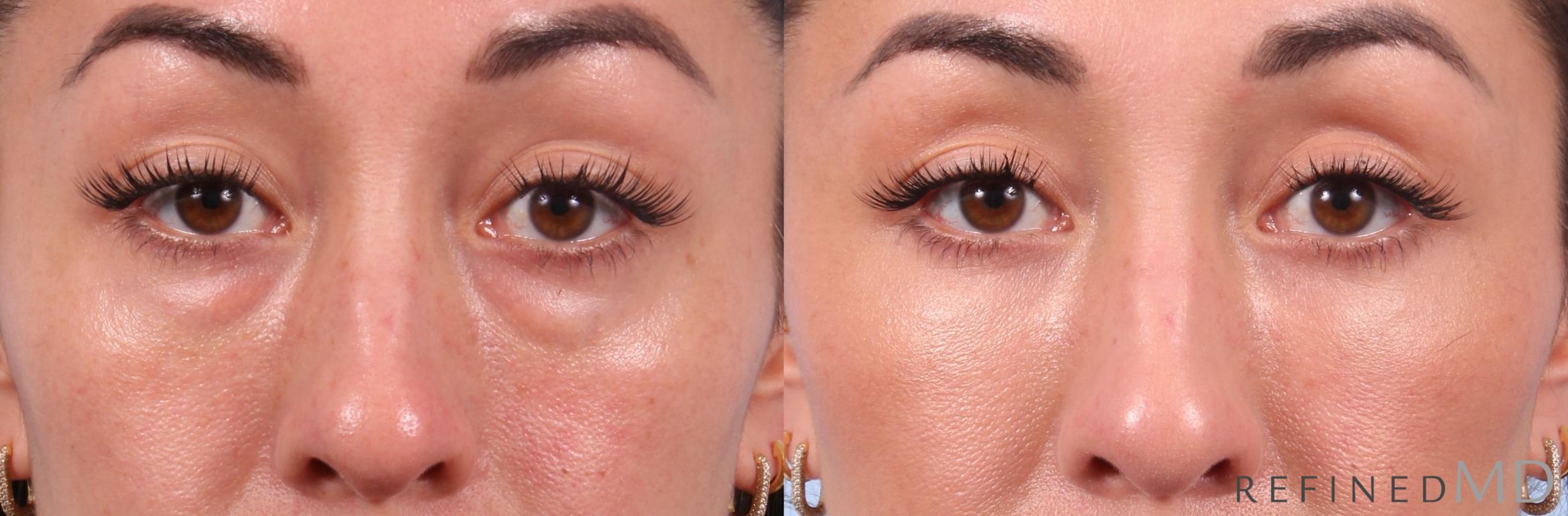 Before & After Lower Eyelid Case 1131 Front View in Los Gatos & San Jose, CA