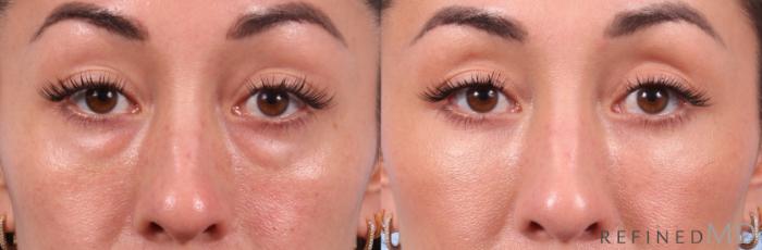 Before & After Lower Eyelid Case 1131 Front View in Los Gatos & San Jose, CA
