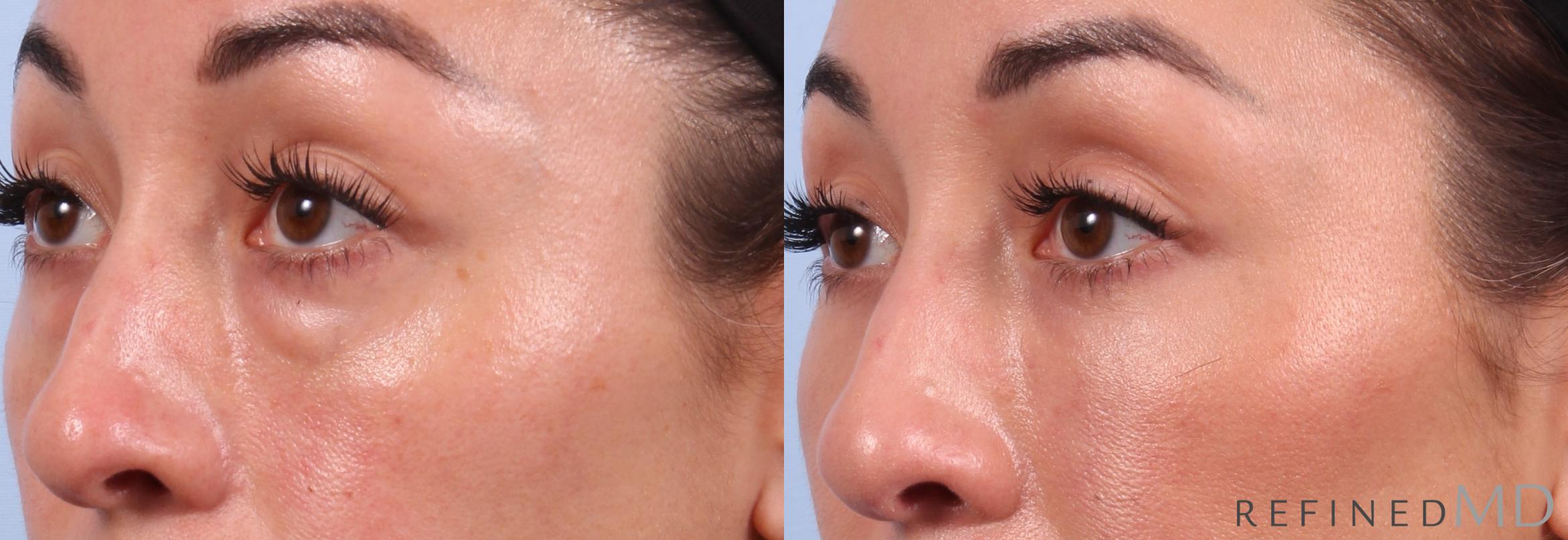Before & After Lower Eyelid Case 1131 Left Oblique View in Los Gatos & San Jose, CA