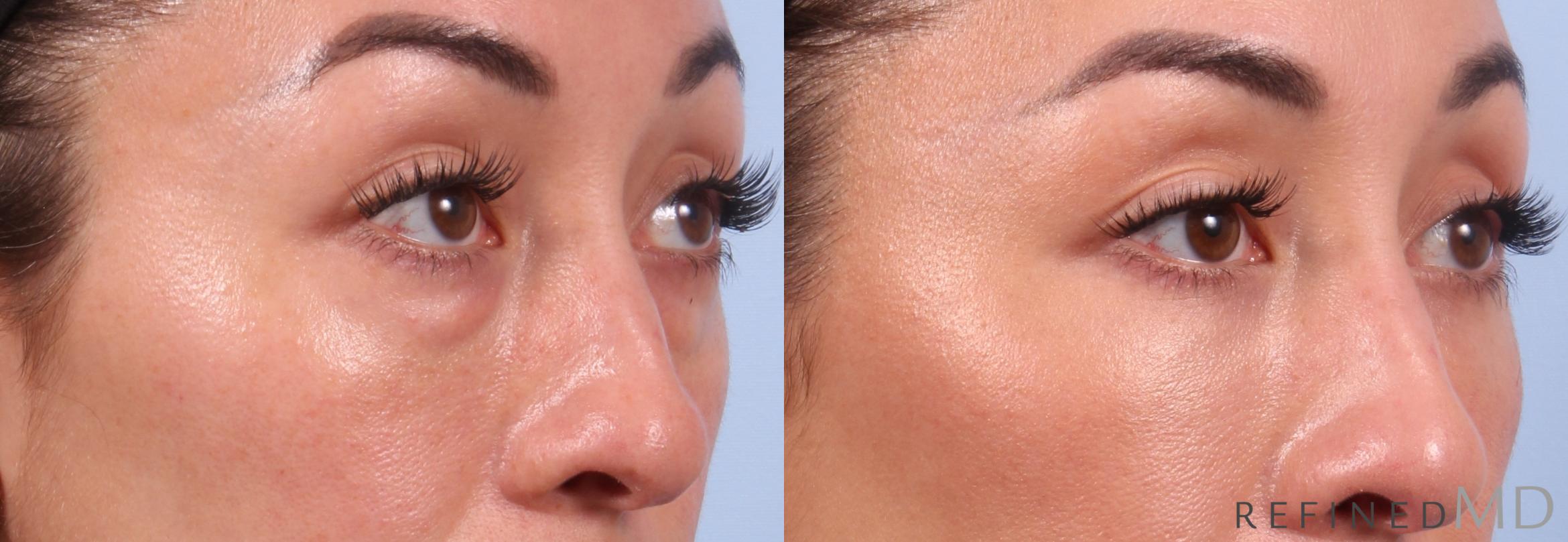 Before & After Lower Eyelid Case 1131 Right Oblique View in Los Gatos & San Jose, CA
