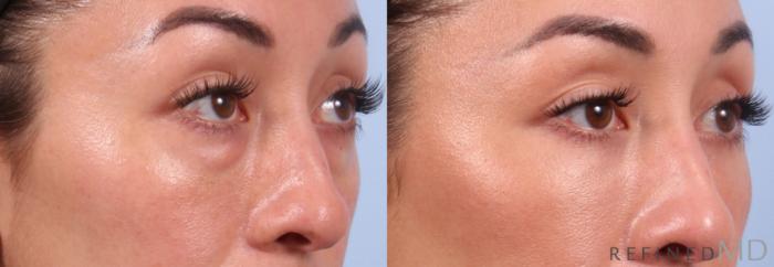 Before & After Lower Eyelid Case 1131 Right Oblique View in Los Gatos & San Jose, CA