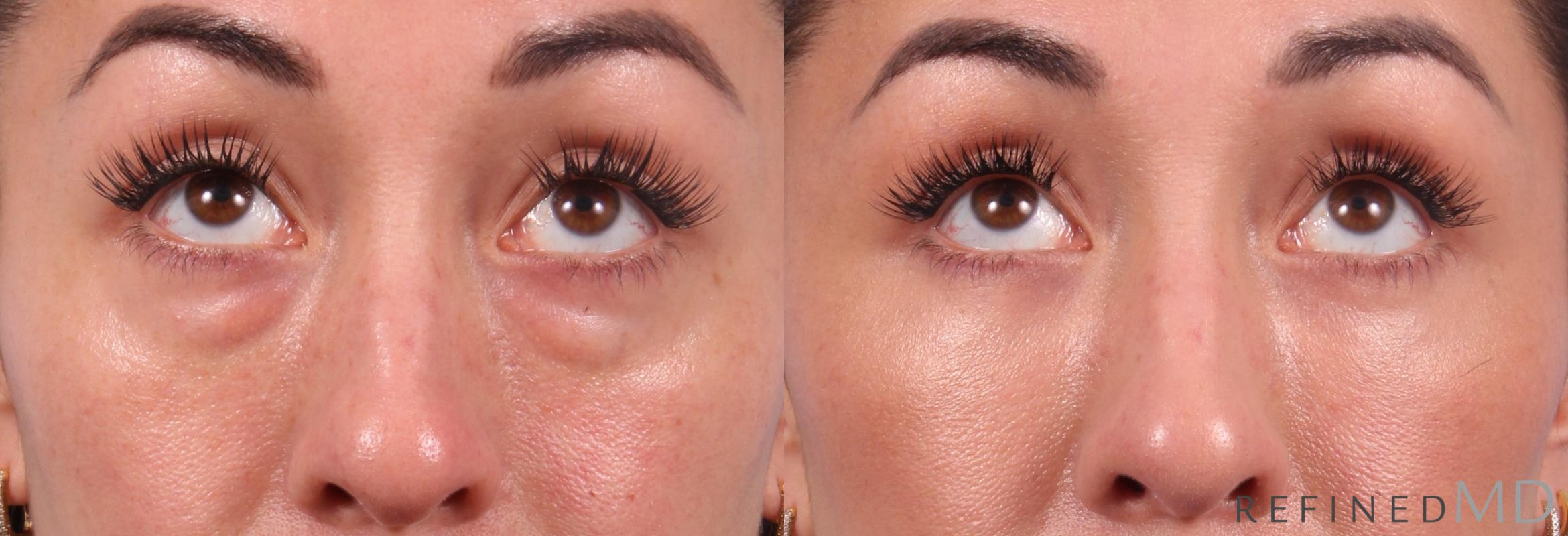 Before & After Lower Eyelid Case 1131 Up Gaze View in Los Gatos & San Jose, CA