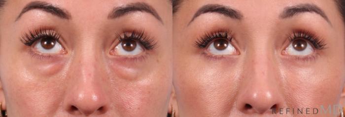 Before & After Lower Eyelid Case 1131 Up Gaze View in Los Gatos & San Jose, CA