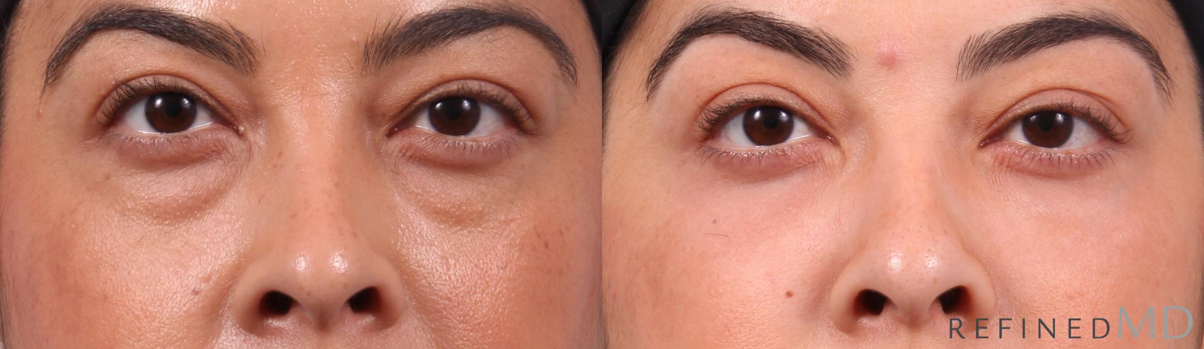 Before & After Lower Eyelid Case 1132 Front View in Los Gatos & San Jose, CA