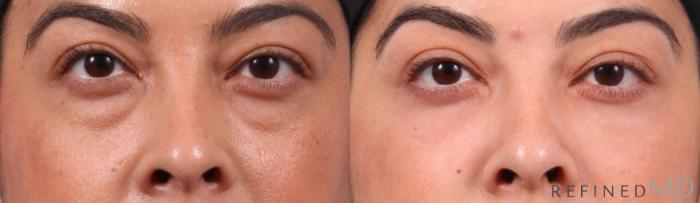 Before & After Lower Eyelid Case 1132 Front View in Los Gatos & San Jose, CA