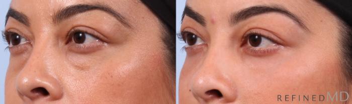 Before & After Lower Eyelid Case 1132 Left Oblique View in Los Gatos & San Jose, CA