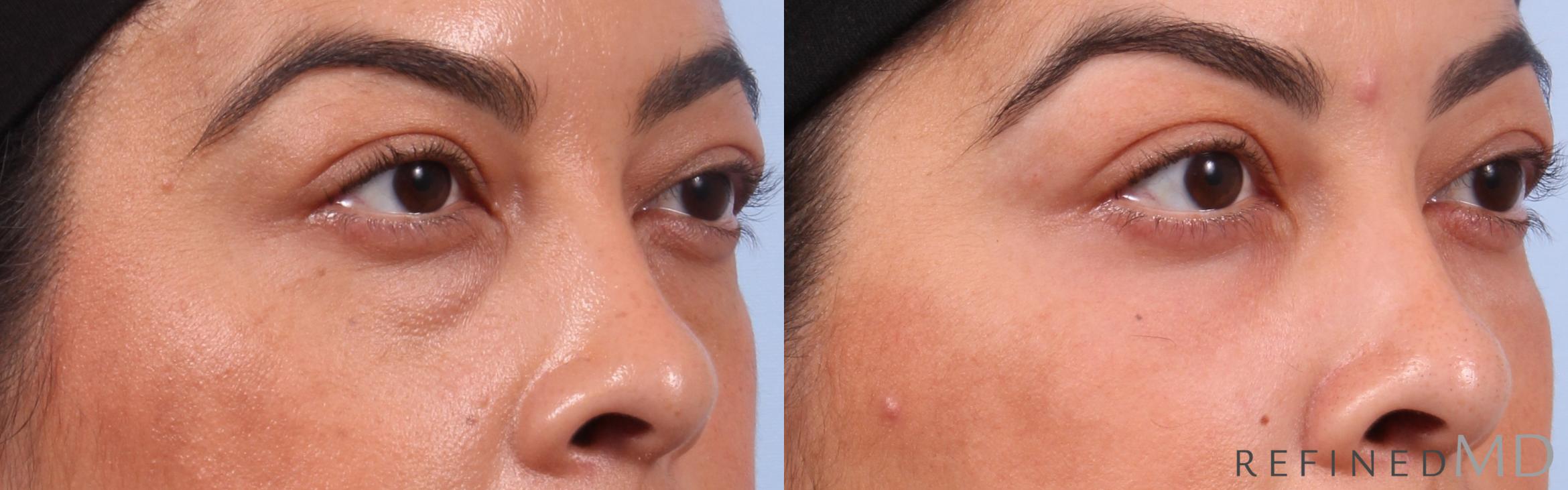 Before & After Lower Eyelid Case 1132 Right Oblique View in Los Gatos & San Jose, CA