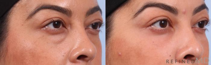Before & After Lower Eyelid Case 1132 Right Oblique View in Los Gatos & San Jose, CA