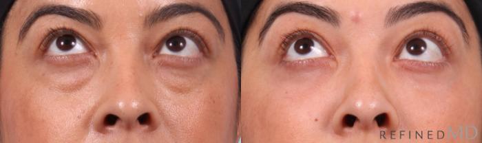Before & After Lower Eyelid Case 1132 Up Gaze View in Los Gatos & San Jose, CA