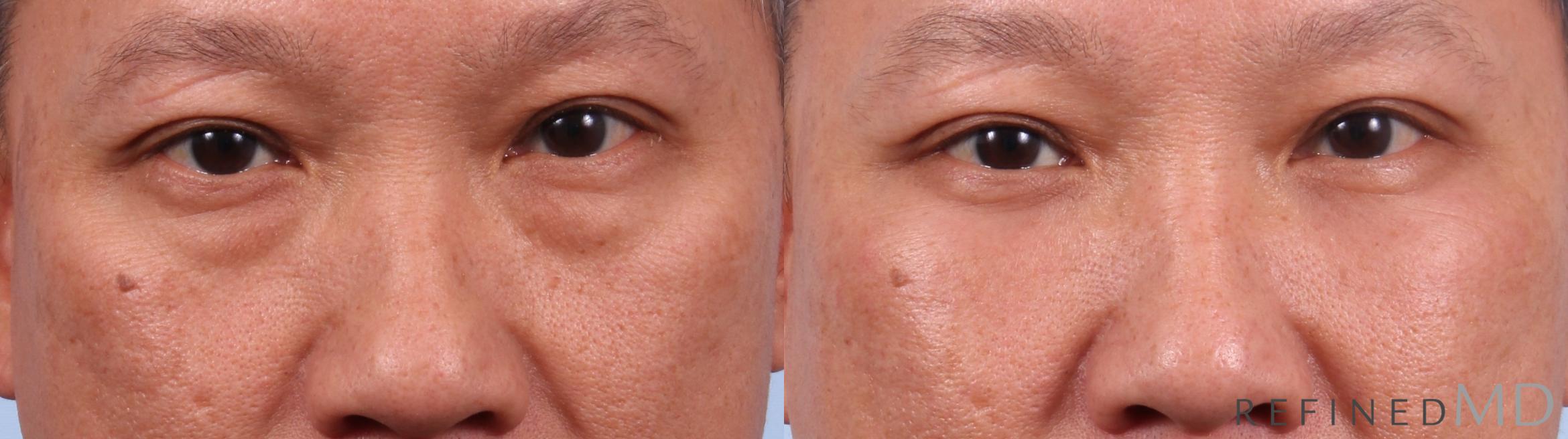 Before & After Lower Eyelid Case 1133 Front View in Los Gatos & San Jose, CA