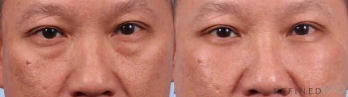Before & After Lower Eyelid Case 1133 Front View in Los Gatos & San Jose, CA