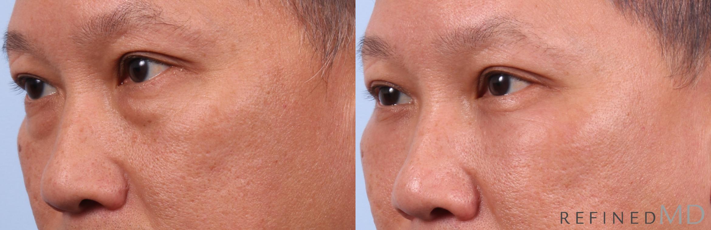 Before & After Lower Eyelid Case 1133 Left Oblique View in Los Gatos & San Jose, CA