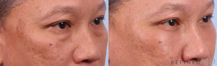 Before & After Lower Eyelid Case 1133 Right Oblique View in Los Gatos & San Jose, CA