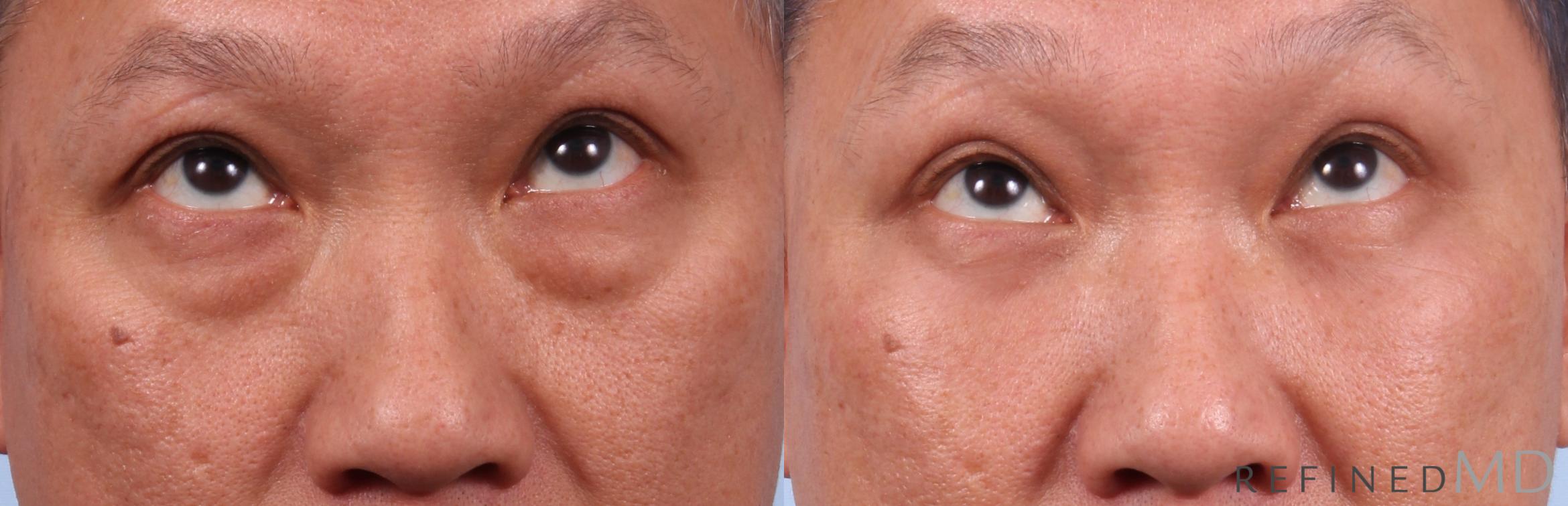 Before & After Lower Eyelid Case 1133 Up Gaze View in Los Gatos & San Jose, CA
