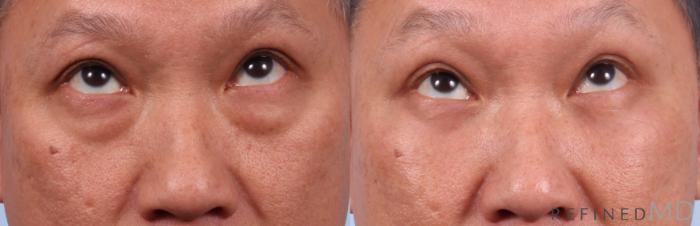 Before & After Lower Eyelid Case 1133 Up Gaze View in Los Gatos & San Jose, CA