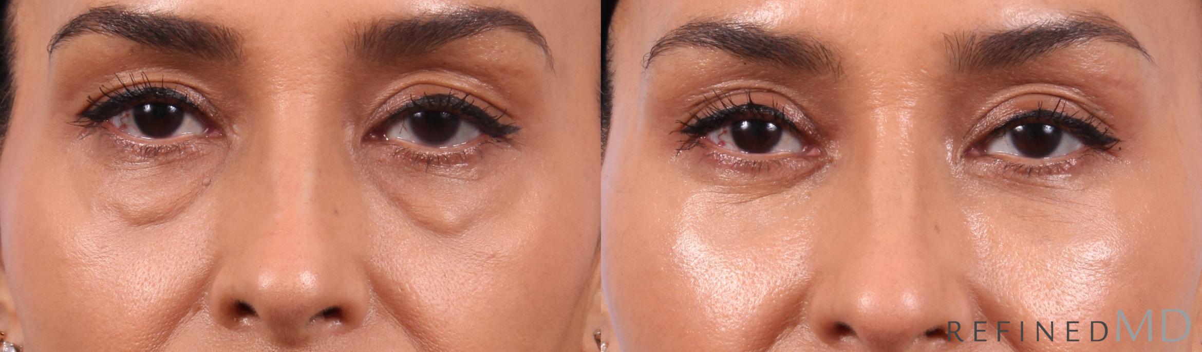 Before & After Lower Eyelid Case 1134 Front View in Los Gatos & San Jose, CA