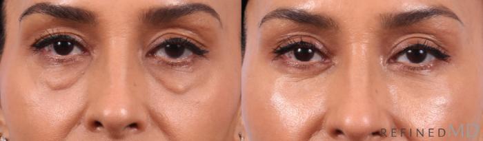 Before & After Lower Eyelid Case 1134 Front View in Los Gatos & San Jose, CA