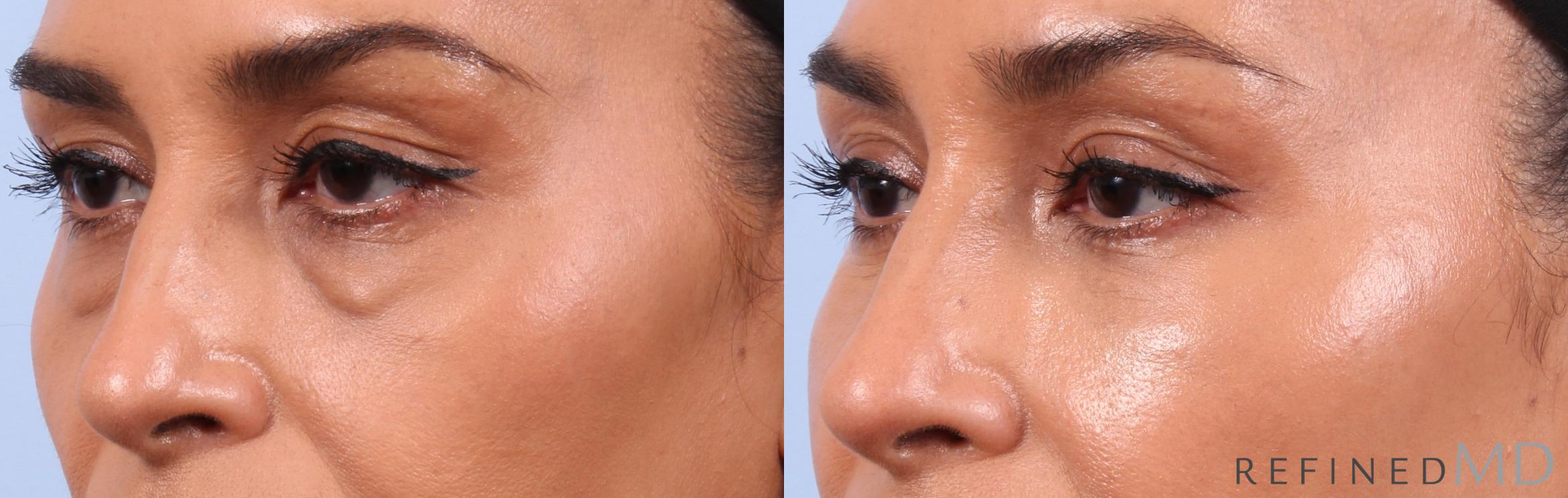 Before & After Lower Eyelid Case 1134 Left Oblique View in Los Gatos & San Jose, CA