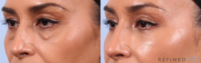 Before & After Lower Eyelid Case 1134 Left Oblique View in Los Gatos & San Jose, CA
