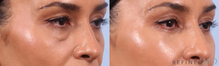 Before & After Lower Eyelid Case 1134 Right Oblique View in Los Gatos & San Jose, CA