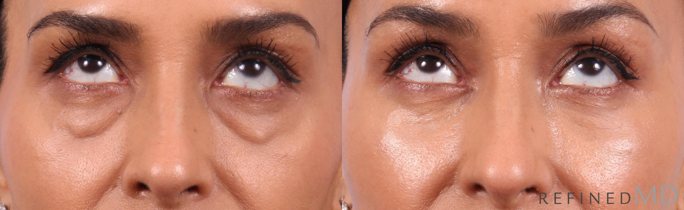 Before & After Lower Eyelid Case 1134 Up Gaze View in Los Gatos & San Jose, CA