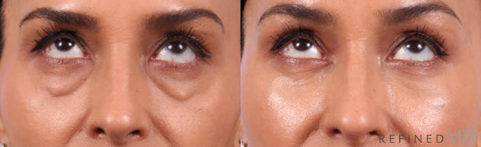 Before & After Lower Eyelid Case 1134 Up Gaze View in Los Gatos & San Jose, CA