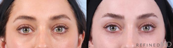 Before & After Lower Eyelid Case 1135 Front View in Los Gatos & San Jose, CA