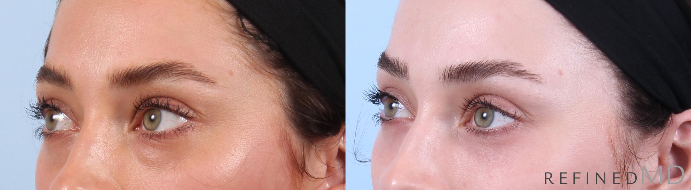 Before & After Lower Eyelid Case 1135 Left Oblique View in Los Gatos & San Jose, CA
