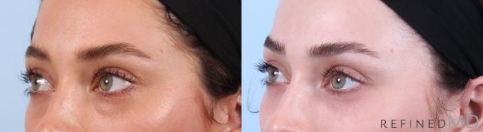 Before & After Lower Eyelid Case 1135 Left Oblique View in Los Gatos & San Jose, CA
