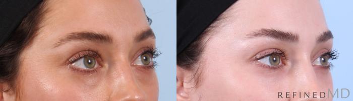 Before & After Lower Eyelid Case 1135 Right Oblique View in Los Gatos & San Jose, CA