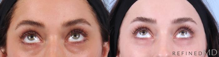 Before & After Lower Eyelid Case 1135 Up Gaze View in Los Gatos & San Jose, CA