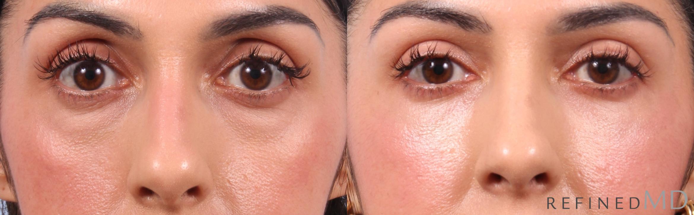 Before & After Lower Eyelid Case 1136 Front View in Los Gatos & San Jose, CA
