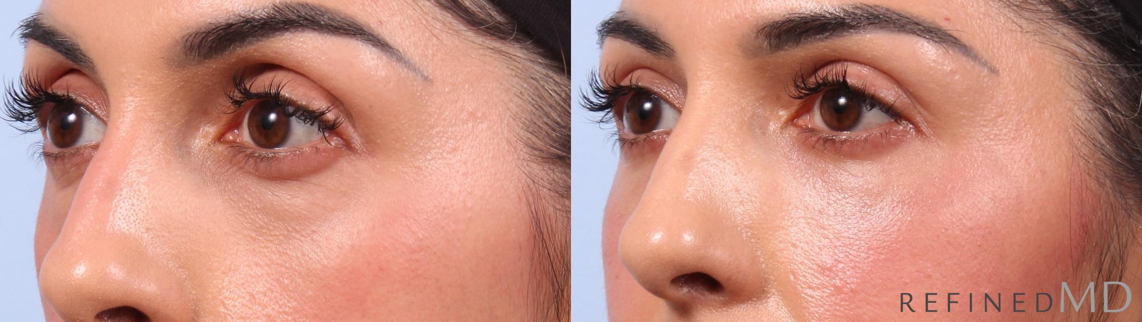 Before & After Lower Eyelid Case 1136 Left Oblique View in Los Gatos & San Jose, CA