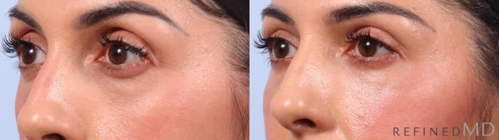 Before & After Lower Eyelid Case 1136 Left Oblique View in Los Gatos & San Jose, CA