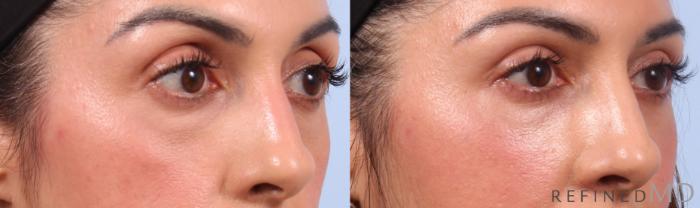 Before & After Lower Eyelid Case 1136 Right Oblique View in Los Gatos & San Jose, CA