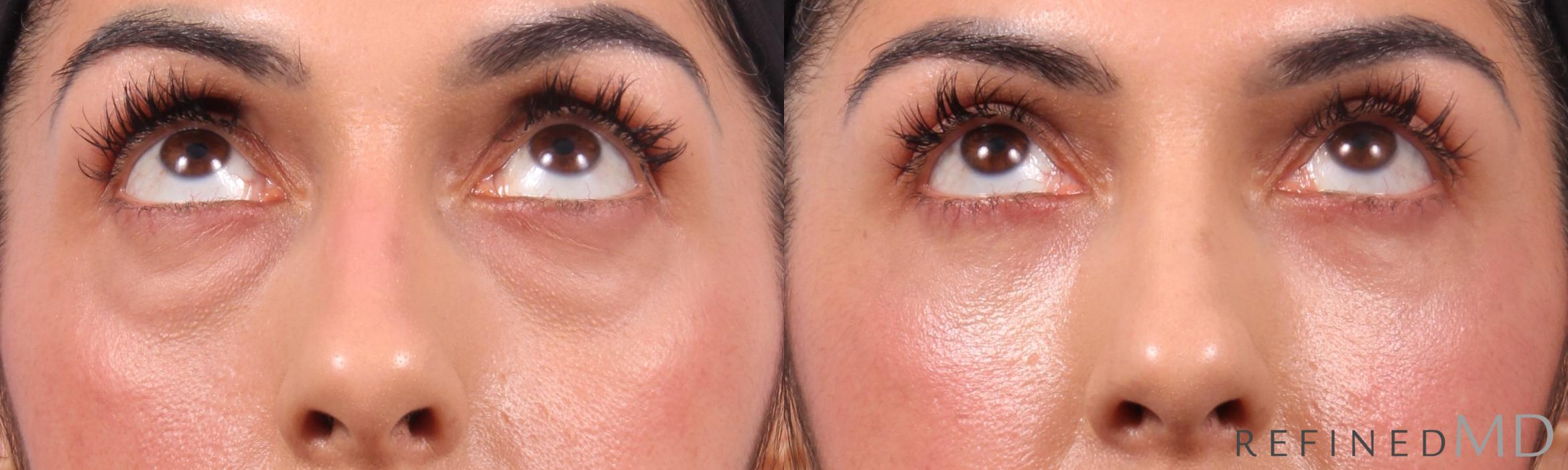 Before & After Lower Eyelid Case 1136 Up Gaze View in Los Gatos & San Jose, CA