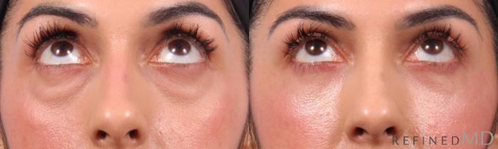 Before & After Lower Eyelid Case 1136 Up Gaze View in Los Gatos & San Jose, CA
