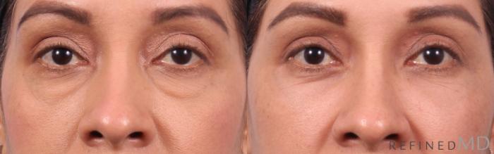 Before & After Lower Eyelid Case 1137 Front View in Los Gatos & San Jose, CA