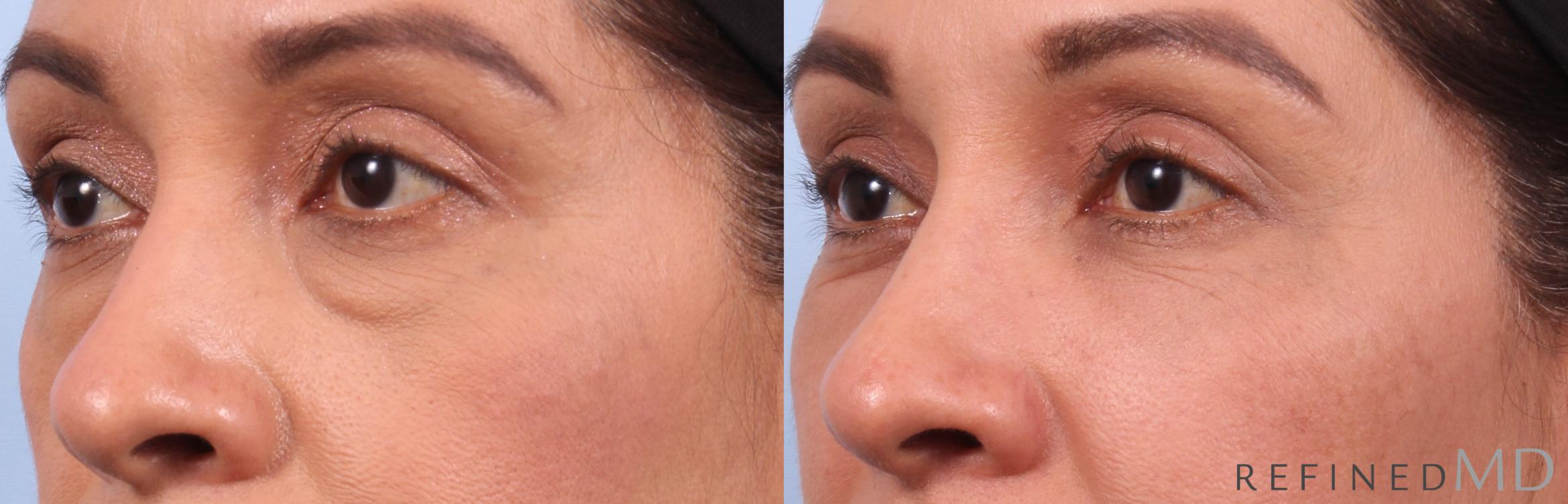 Before & After Lower Eyelid Case 1137 Left Oblique View in Los Gatos & San Jose, CA