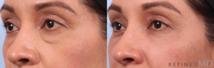 Before & After Lower Eyelid Case 1137 Left Oblique View in Los Gatos & San Jose, CA